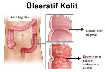 Ulseratif Kolit